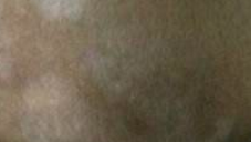 白癜风发病年龄，逐年趋于年轻化，从小开始预防，注意这4点