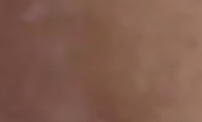 青少年白癜风的护理方法