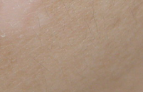 不同类型白癜风症状有哪些具体表现