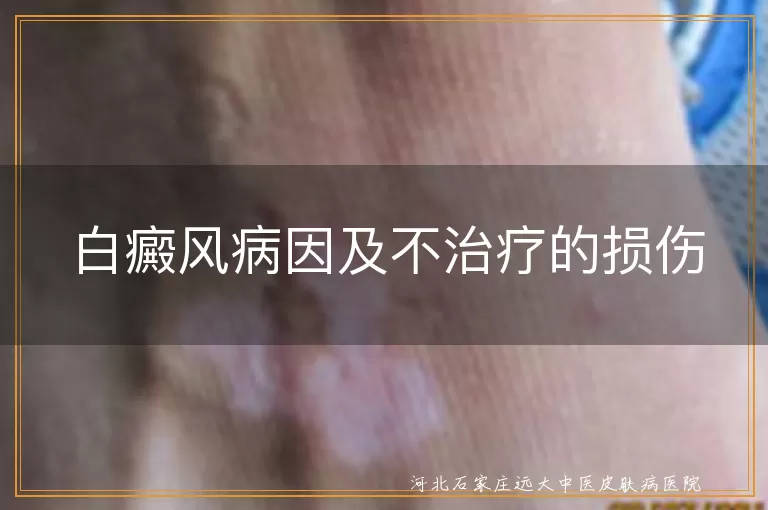 白癜风病因及不治疗的损伤