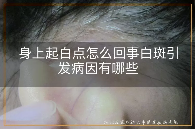 白癜风白点常见诱因,白斑早期辨识指南,身上白癜风病因解析