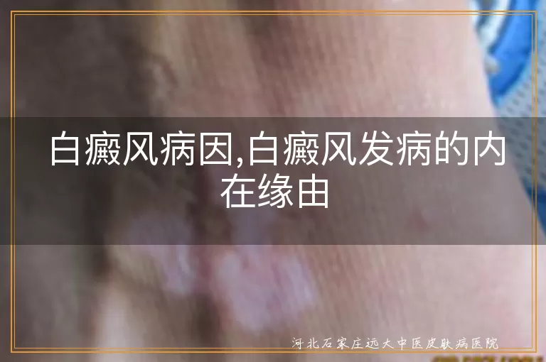 白癜风病因,白癜风发病的内在缘由