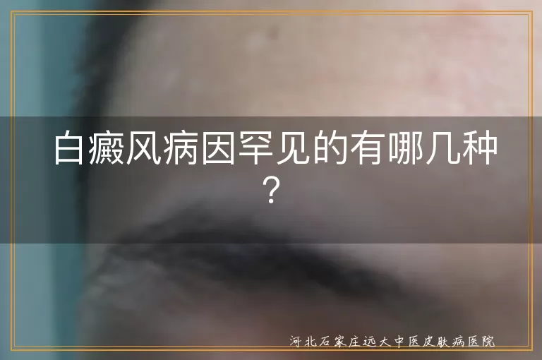 白癜风病因罕见的有哪几种？
