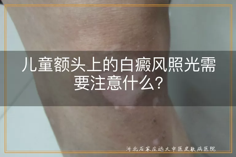 儿童白癜风,照光治疗,正规医院,保护皮肤,家长陪伴,剂量核对,皮肤护理,饮食调整,心理变化,定期复查