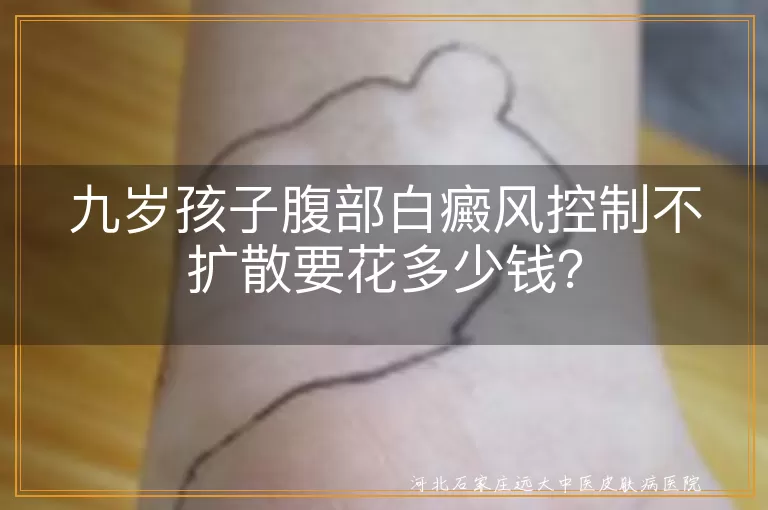 九岁孩子,腹部白癜风,控制不扩散,治疗费用,影响因素,节省开支