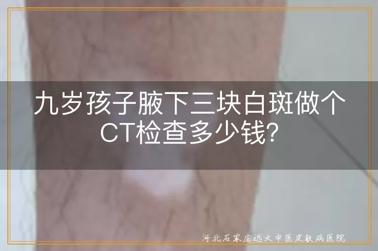 CT检查,白斑,费用,医院等级,地区,白癜风,花斑癣,伍氏灯检查,皮肤镜检查,病理检查