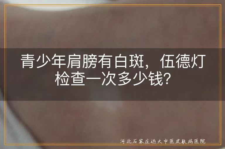 伍德灯检查,白斑,青少年,价格,花斑癣,白癜风