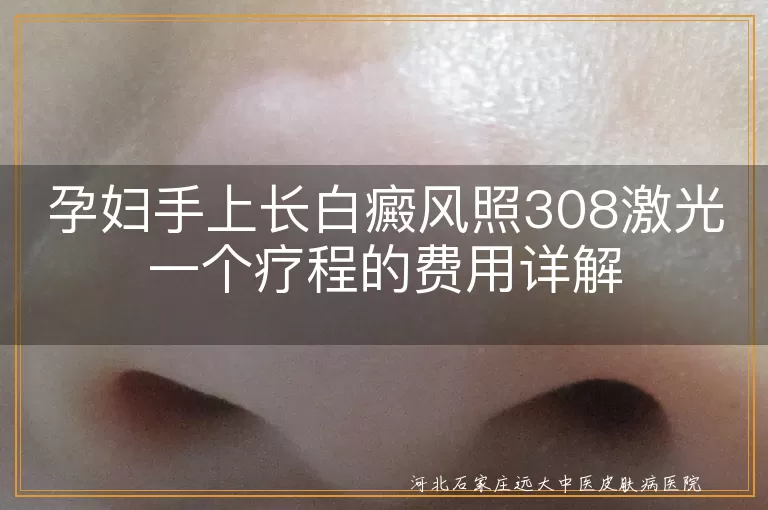 孕妇,白癜风,308激光治疗,费用,疗程,影响因素