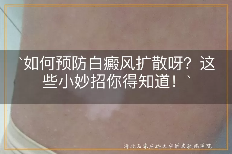 白癜风,扩散,防晒,生活习惯,外伤,定期检查,心态调整