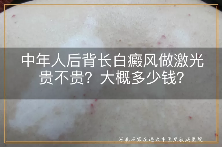 白癜风,激光治疗,费用,病情,医院等级,地区差异,治疗次数,正规医院