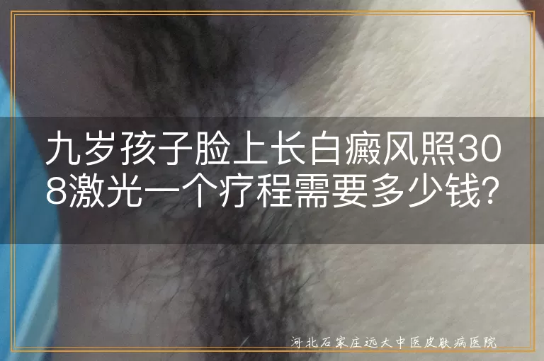 白癜风,308激光治疗,费用,医院类型,地区,白斑面积