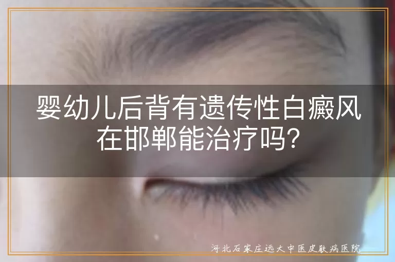 婴幼儿,遗传性白癜风,邯郸白癜风专科医院,个性化治疗,心理疏导