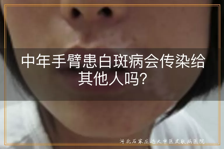 白斑病,白癜风,传染性,遗传,自身免疫,精神因素,治疗,护理