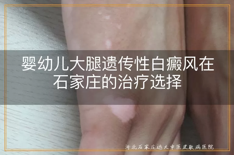 婴幼儿白癜风,石家庄治疗,专业医院,外用药物,光疗,心理支持
