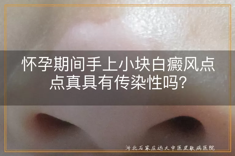 怀孕,白癜风,传染性,遗传,治疗,心态,饮食,医生建议