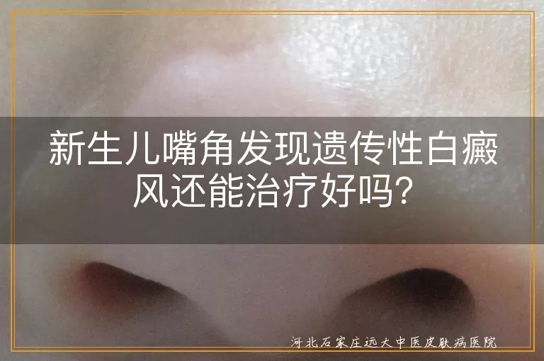 新生儿,遗传性白癜风,及早发现,科学治疗,防晒,合理饮食,心态调整