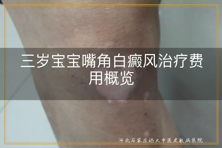 三岁宝宝,白癜风,治疗费用,影响因素,合理规划