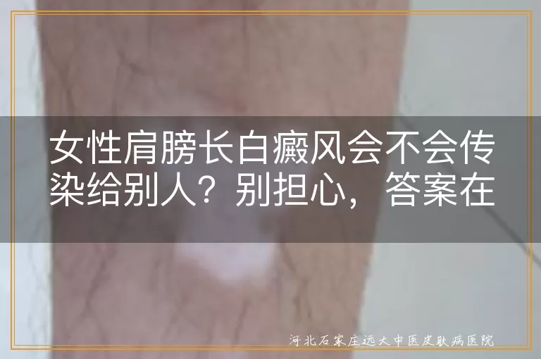 白癜风,传染性,女性,肩膀,遗传,治疗,预防