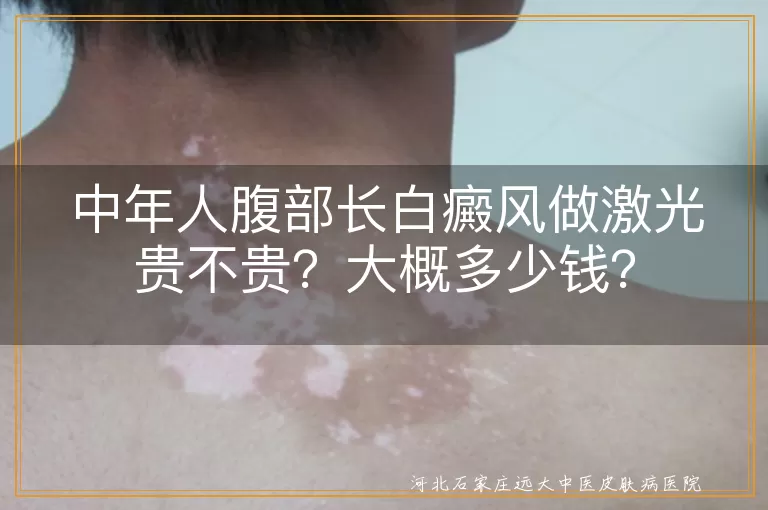 白癜风,激光治疗,费用,影响因素,治疗效果,安全性,生活习惯