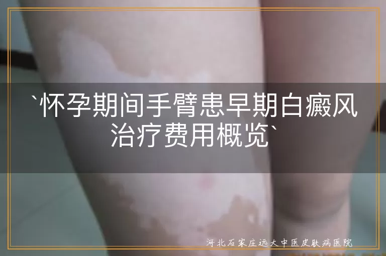 怀孕期间,白癜风,治疗费用,病情严重程度,治疗方法,医院等级,个人体质