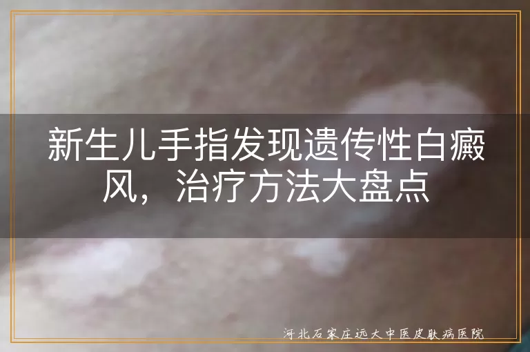 新生儿,遗传性白癜风,治疗方法,日常护理,药物治疗,物理治疗,手术治疗,心理治疗,预防与注意事项