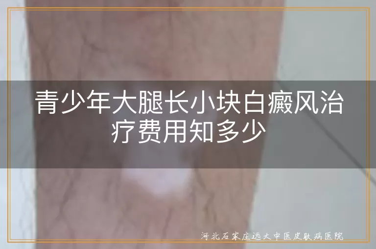 青少年,大腿,白癜风,治疗费用,影响因素,药物治疗,光疗,手术治疗