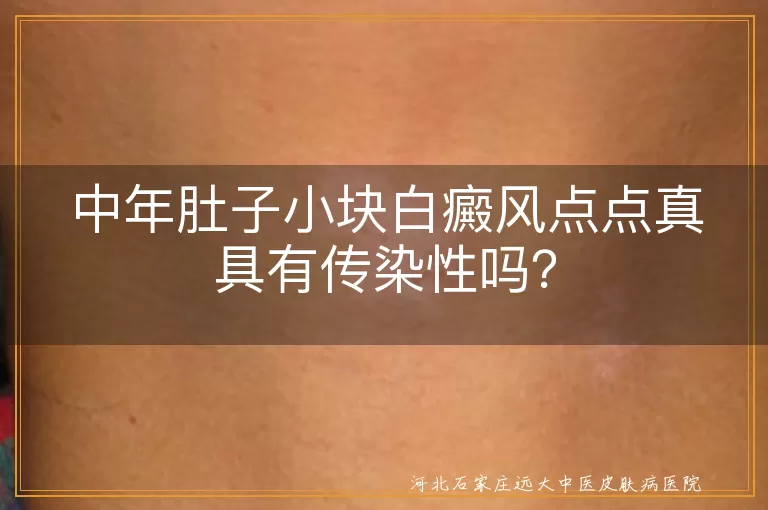 白癜风,传染性,黑色素代谢紊乱,科学治疗,日常护理