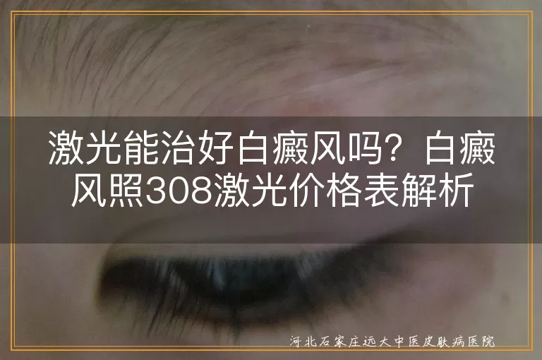 白癜风,激光治疗,308nm准分子激光,治疗费用,效果因人而异