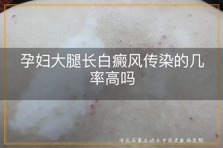 白癜风,孕妇,传染性,遗传性,日常护理,心态平和