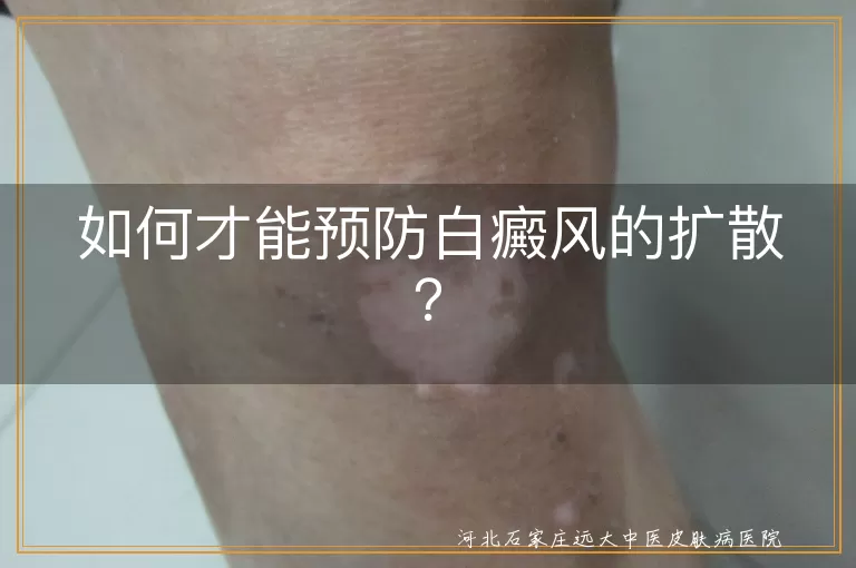 白癜风,扩散,预防,生活习惯,皮肤保护,治疗,心态调整
