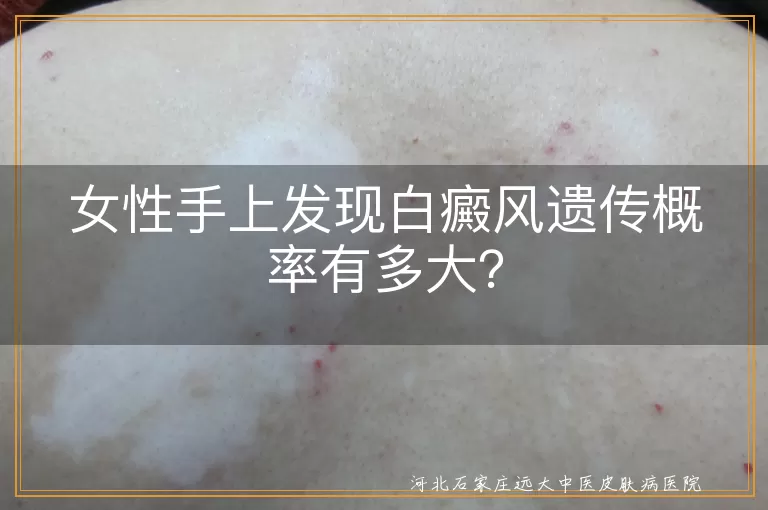 白癜风,遗传概率,女性,手上,治疗,预防