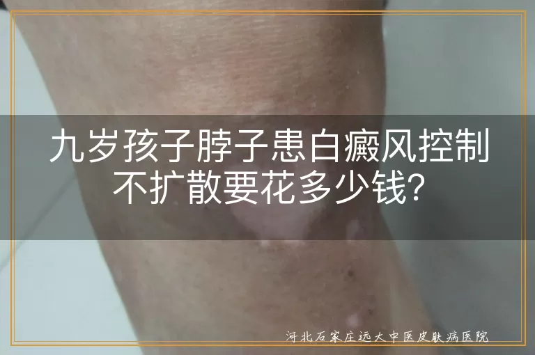 白癜风,治疗费用,九岁孩子,病情控制,药物治疗,光疗,激光治疗,手术治疗,医疗保险