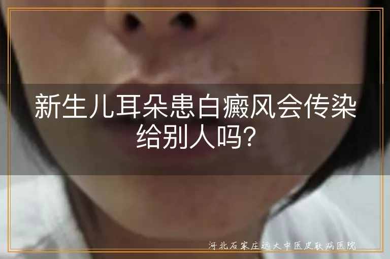 新生儿,白癜风,不传染,遗传因素,自身免疫,日常护理,预防措施