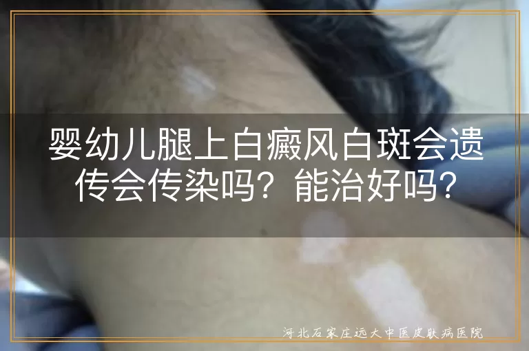 婴幼儿,白癜风,白斑,遗传,传染,治疗,护理,心理因素