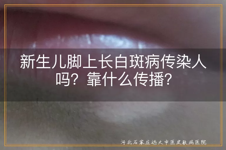 新生儿,白斑病,白癜风,传染,治疗,护理