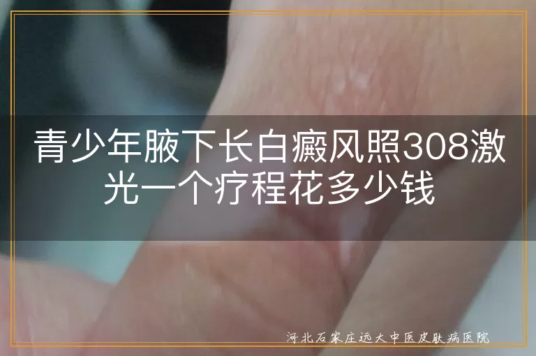 青少年,白癜风,308激光治疗,费用,疗程,影响因素,治疗效果