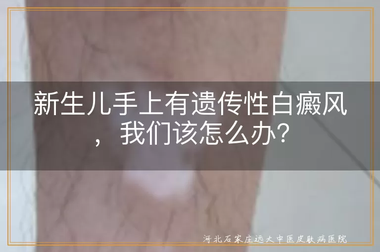 新生儿,遗传性白癜风,治疗,就医,光疗,日常护理,预防复发