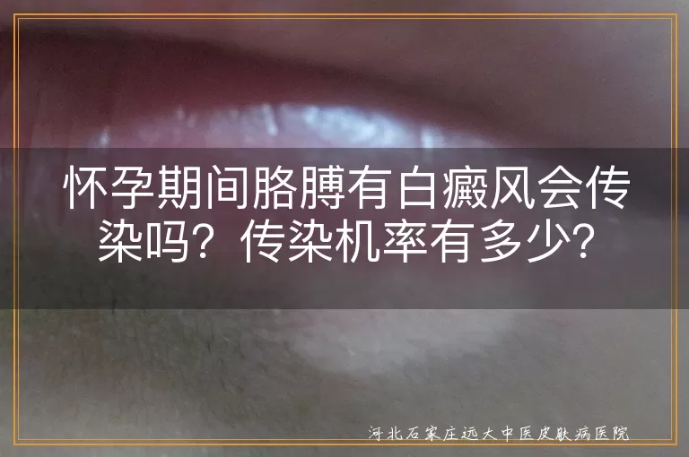 白癜风,怀孕,传染,遗传几率,日常护理,防晒,专业医生,光疗