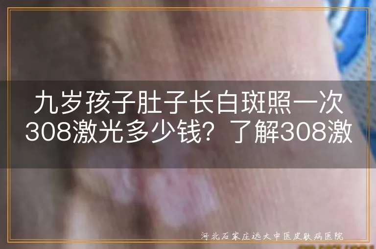 308激光治疗,白斑,费用,设备价格,白癜风,儿童治疗