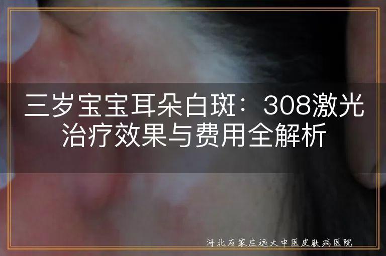 308激光治疗,白斑,白癜风,儿童,费用,效果,治疗周期,防晒