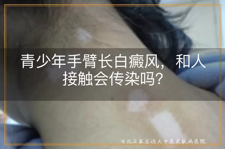 青少年,白癜风,传染,皮肤病,黑色素细胞,遗传因素,自身免疫,精神因素,环境因素,理解支持,积极治疗,减少歧视
