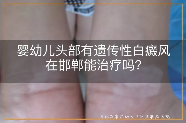 婴幼儿,头部,遗传性白癜风,邯郸,治疗,药物,物理疗法,日常护理,多学科协作,家长注意事项