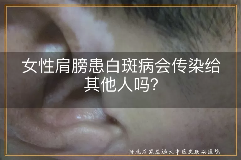白斑病,白癜风,传染性,治疗,遗传
