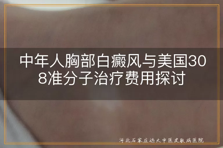 中年人,白癜风,美国308准分子激光,治疗费用,疗效
