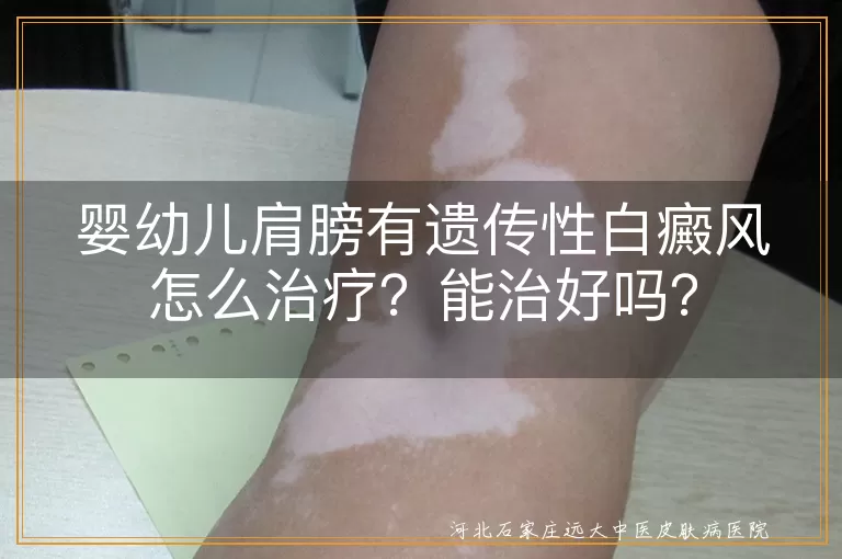 婴幼儿,遗传性白癜风,治疗方法,治愈希望,科学治疗,心理疏导