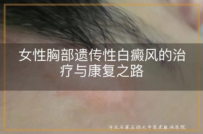 遗传性白癜风,女性胸部,治疗方法,药物治疗,物理治疗,手术治疗,康复之路,信心与坚持