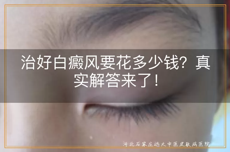 白癜风,治疗费用,病情轻重,治疗方法,医院类型,地区差异,综合治疗,日常护理