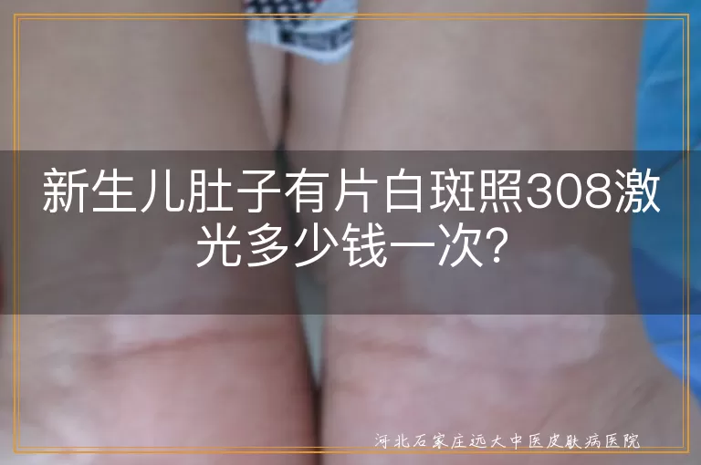 新生儿,白斑,308激光,治疗费用,医院级别,白斑面积