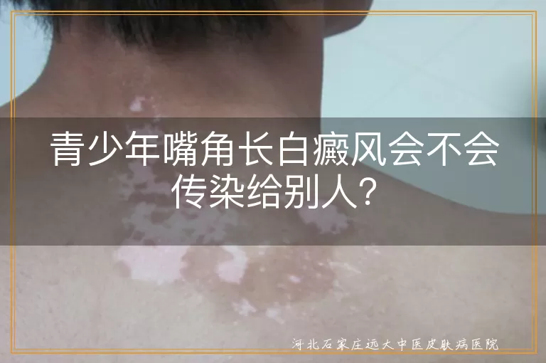青少年,嘴角,白癜风,不传染,治疗,预防,生活习惯,心态调整