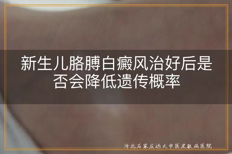 白癜风,遗传,治疗,预防,生活方式